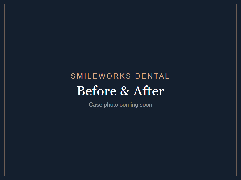 After - Cosmetic Bonding