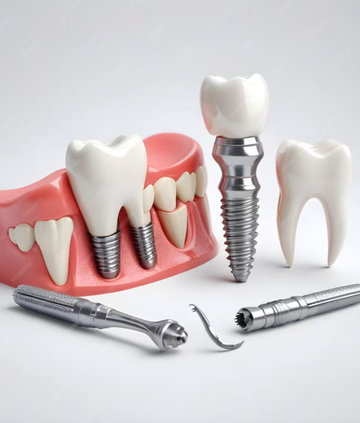 Dental Implants